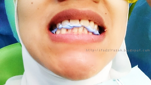 Mould invisalign