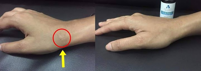 Cara hilangkan parut di badan