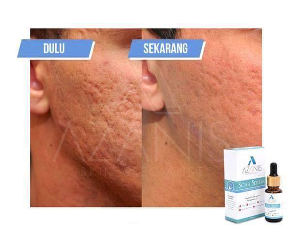 Cara hilangkan parut jerawat