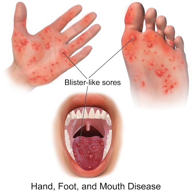 Penyakit Tangan, Mulut Dan Kaki (HMFD)
